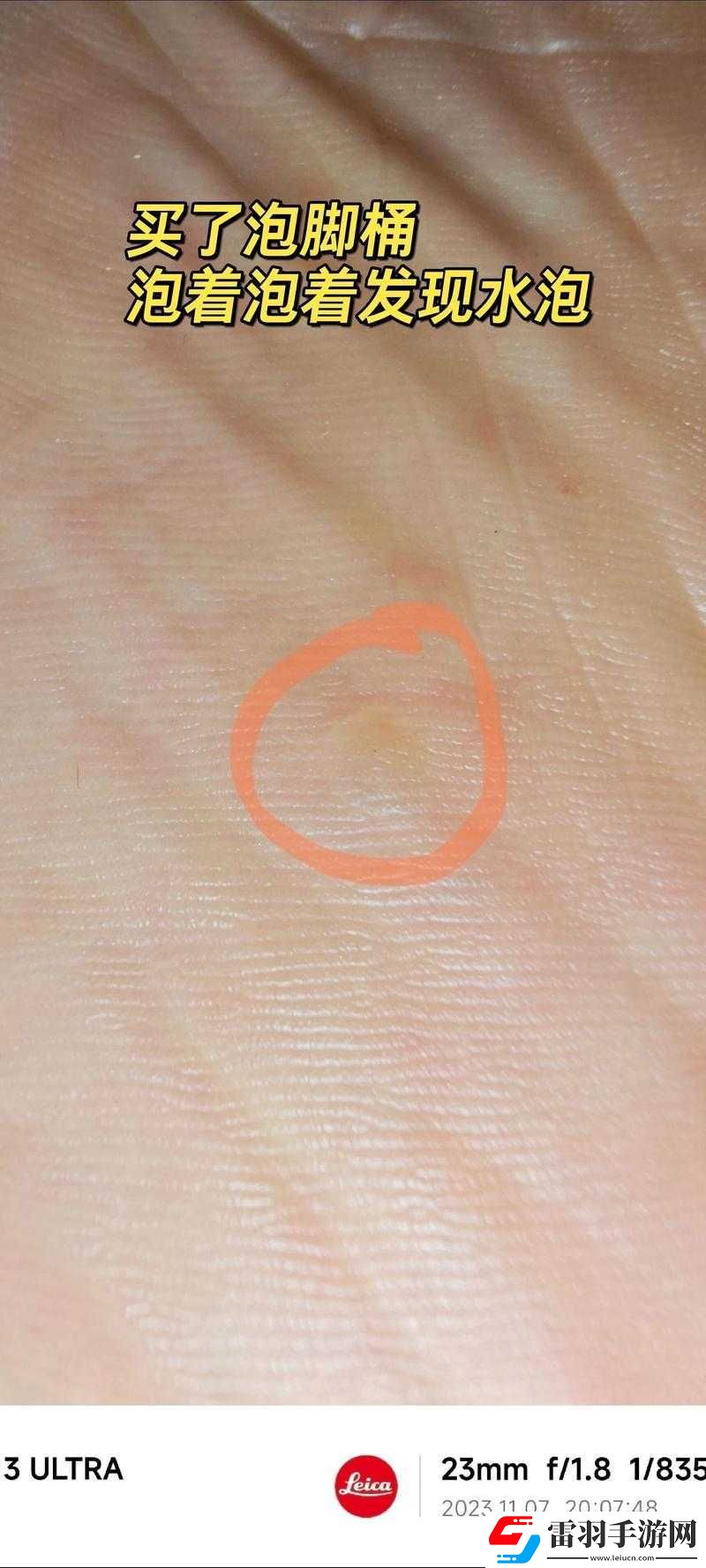 腳底長了像水泡一樣的東西很癢該怎么辦如何解決
